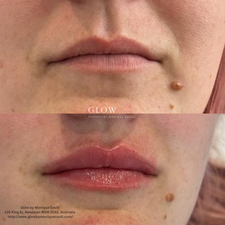 Lip Filler Injections at Glow by Monique Savill Newtown, NSW