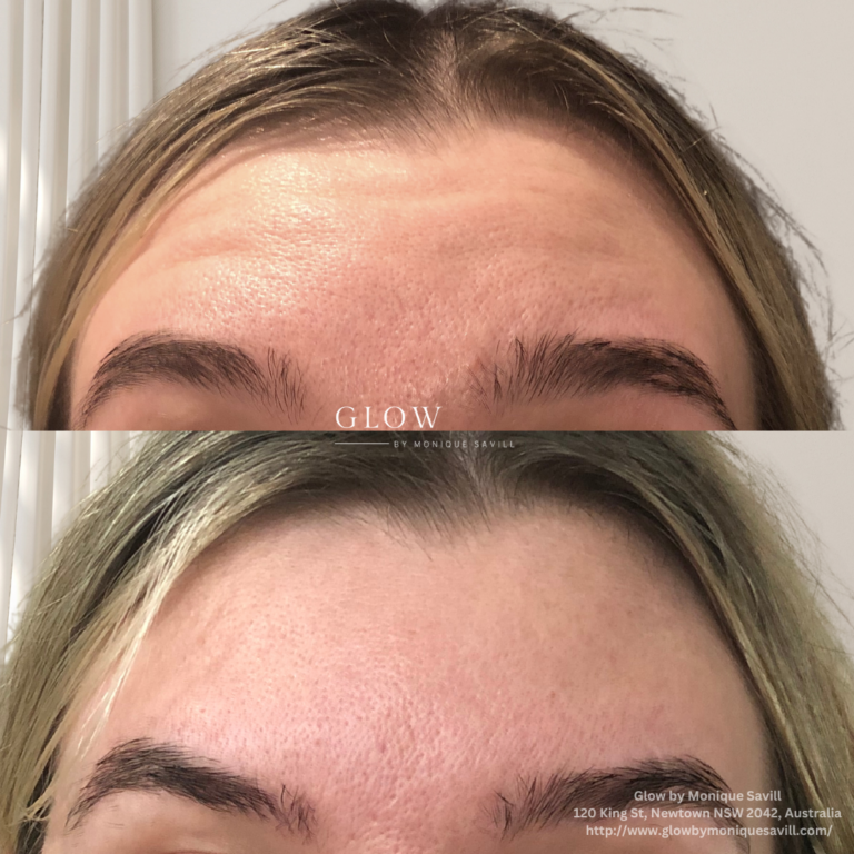 Anti Wrinkle Injections at Glow by Monique Savill Nwtown, NSW