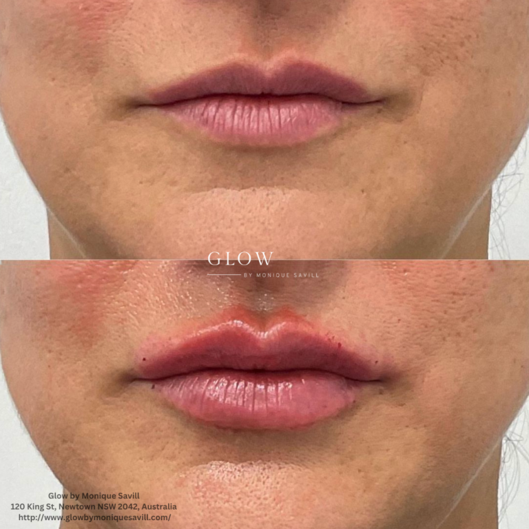 Lip Enhancement With Dermal Fillers at Glow by Monique Savill Newtown, NSW