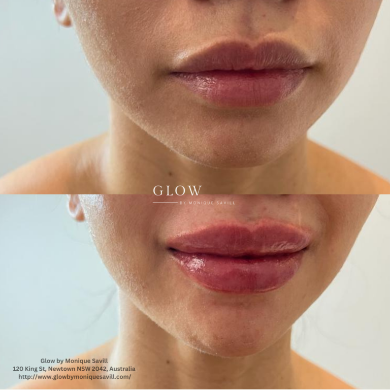 Lip Fillers at Glow by Monique Savill Newtown, NSW